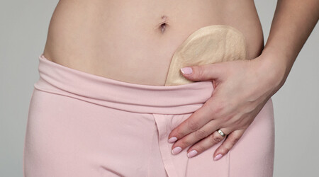 Stomaträgerin als Modell, Detailansicht des Bauchbereichs einer Frau mit dezent präsentierter Stomaversorgung unter rosafarbener Kleidung, diskret und ästhetisch dargestellt.